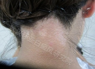 早期治疗白癜风怎么治疗
