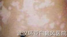 白癜风是什么原因引起的