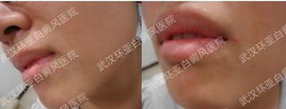 白癜风是怎么引起的