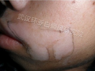 白癜风偏方是否有效