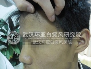 白癜风的治疗需要注意什么