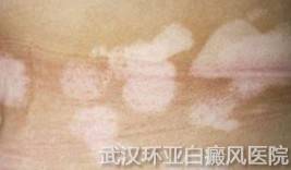 治疗青少年白癜风有哪些要点