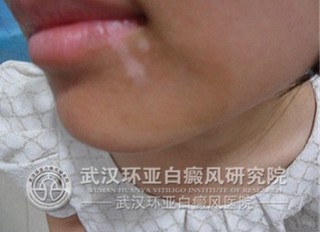 季节变化对白癜风的病情有影响吗