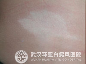 白癜风的出现是哪些原因引起的