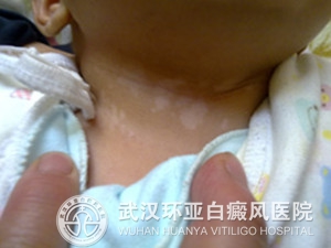 什么是儿童白癜风症状