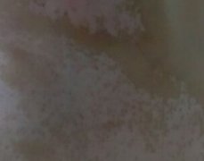 武汉日常有哪些措施可以护理女性白癜风的呢?